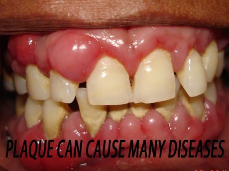 Plaque can cause more than gum disease!!
