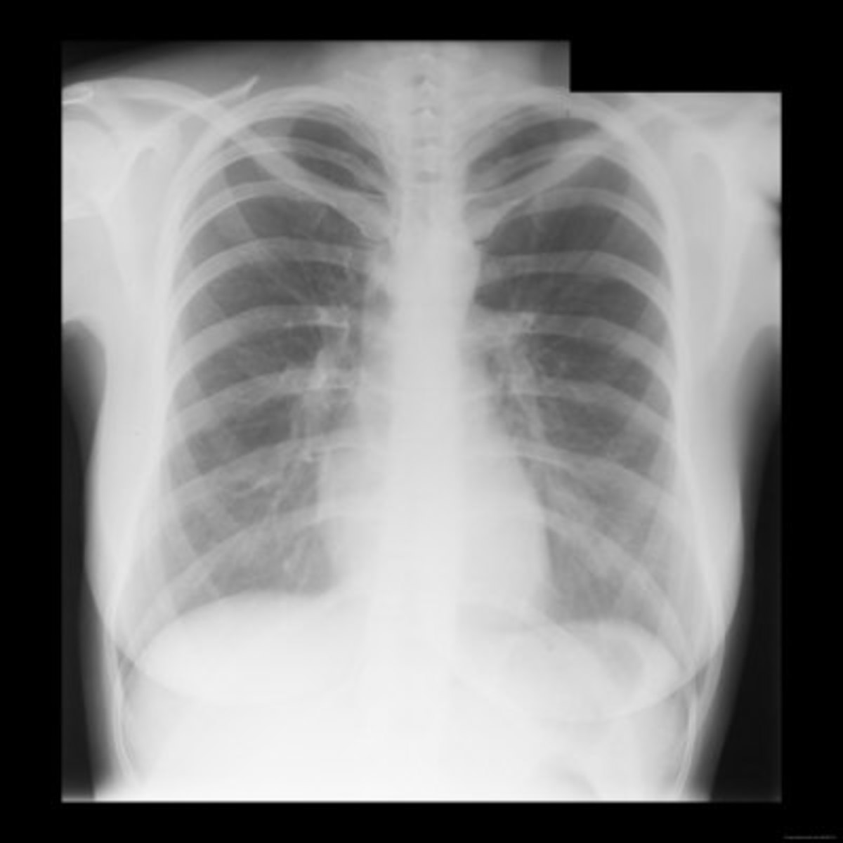 Reading The Chest X-Ray (Chest Radiography): Identifying A ...