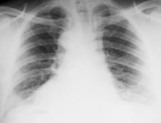 Diagnosing Anthrax Through X-ray Pictures: Different Radiographic ...