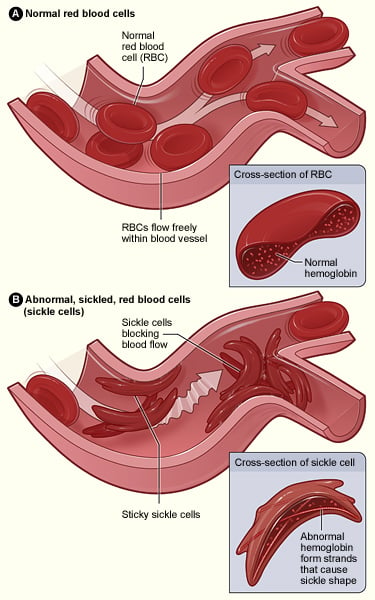 Illustration comparing healthy red blood cells and sickle-cells.
