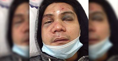 The mauled face of Ferdinand 'Vhong' Navarro (Photo Source: http://www.abs-cbnnews.com/)
