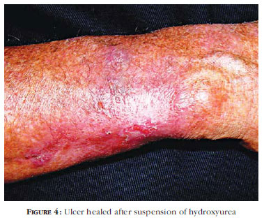Cutaneous effects after prolongaded use of hydroxyurea in Polycythemia Vera