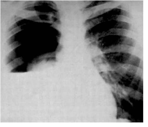 Hemothorax is usually a consequence of blunt or penetrating trauma. Much less commonly, it may be a complication of disease, may be iatrogenically induced, or may develop spontaneously.