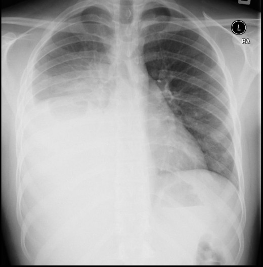 Injury to the heart can produce a hemothorax if a communication exists between the pericardium and the pleural space. Injury to the pulmonary parenchyma may cause hemothorax, but it is usually self-limited because pulmonary vascular pressure is norma