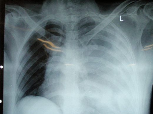 A variety of unusual congenital pulmonary abnormalities, including intralobar and extralobar sequestration, hereditary telangiectasia, and congenital arteriovenous malformations, can cause hemothorax. 