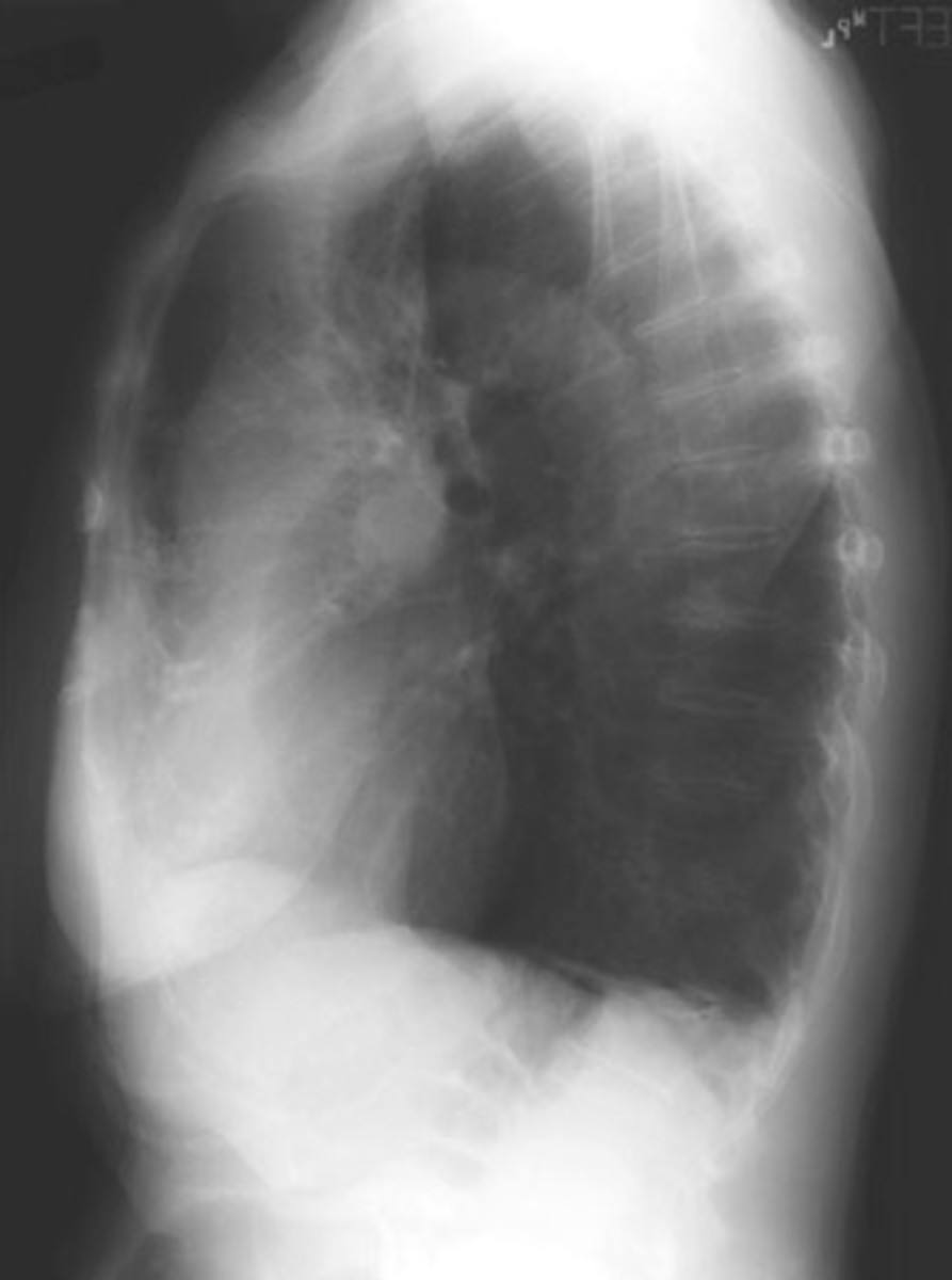 Pneumonia Manifestation Seen And Diagnosed Via X