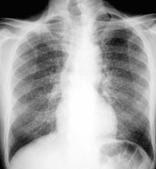 Tuberculosis typically attacks the lungs, but can also affect other parts of the body. It is spread through the air when people who have an active TB infection cough, sneeze, or otherwise transmit respiratory fluids through the air