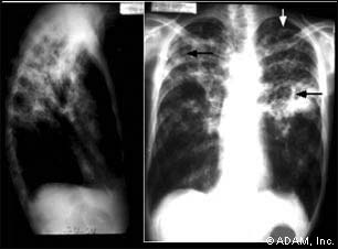 Infection of other organs causes a wide range of symptoms. Diagnosis of active TB relies on radiology (commonly chest X-rays), as well as microscopic examination and microbiological culture of body fluids.