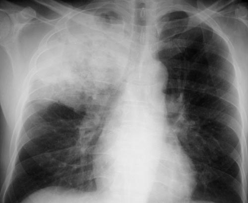 Tuberculosis may infect any part of the body, but most commonly occurs in the lungs (known as pulmonary tuberculosis).