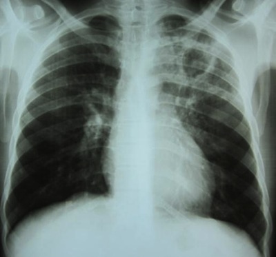 A diagnosis of TB should, however, be considered in those with signs of lung disease or constitutional symptoms lasting longer than two weeks.