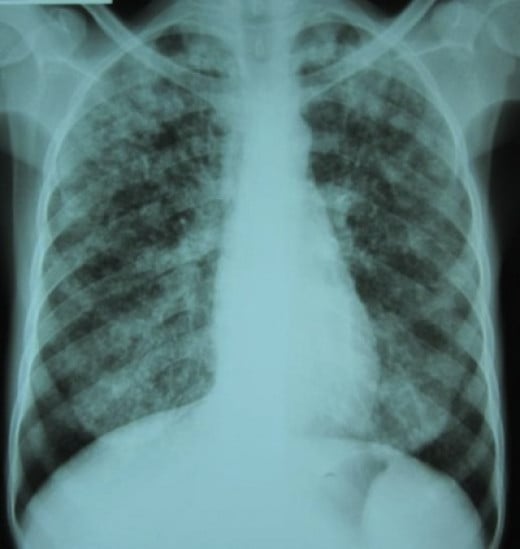 Tuberculosis As Seen In Radiographs: X-Rays Showing The Lungs Affection ...