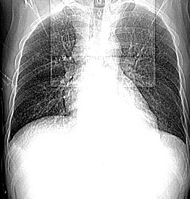 The test may be falsely negative in those with sarcoidosis, Hodgkin's lymphoma, malnutrition, or most notably, in those who truly do have active tuberculosis