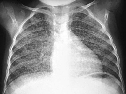 However, in the majority of cases, a latent infection occurs with no obvious symptoms. These dormant bacilli produce active tuberculosis in 5–10% of these latent cases, often many years after infection