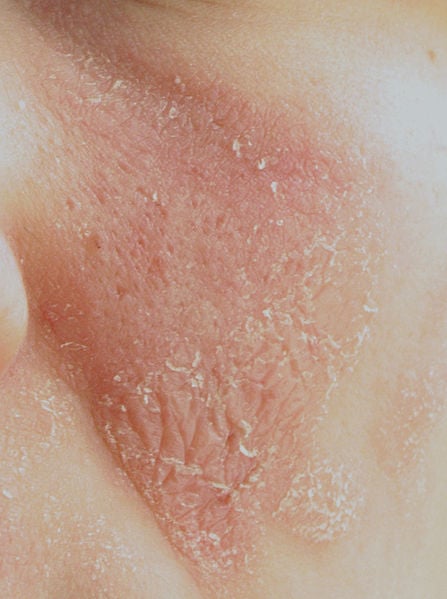 Inflammation and flaking rash on a young woman's cheek; allergic reaction to antibiotic pills.
