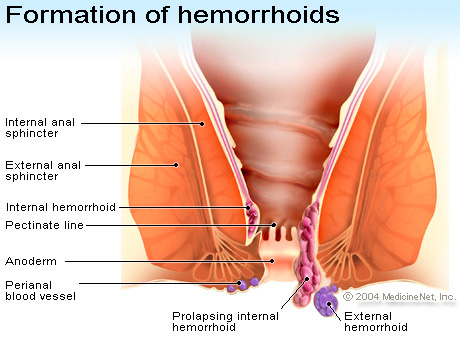 Hemorrhoids in the hand are worth two in the...