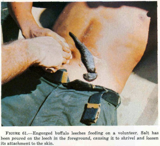 A smallish Buffalo Leech being removed by salt poisoning from a volunteer's back.  Would you do that?