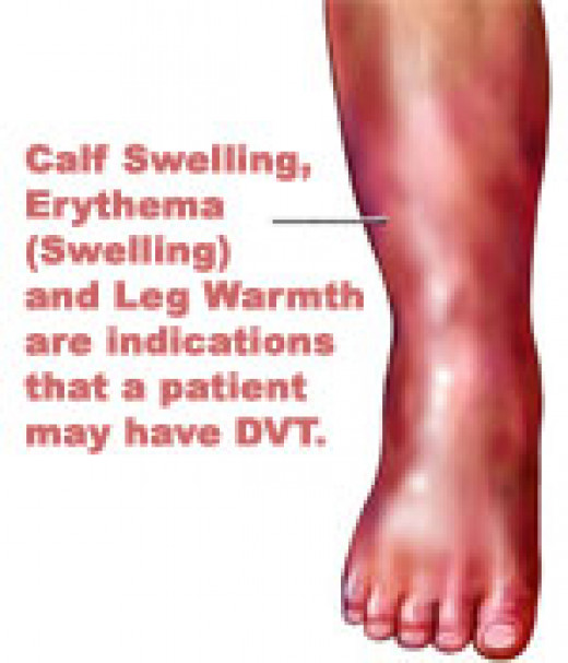 DVT What Is A Deep Vein Thrombosis? hubpages