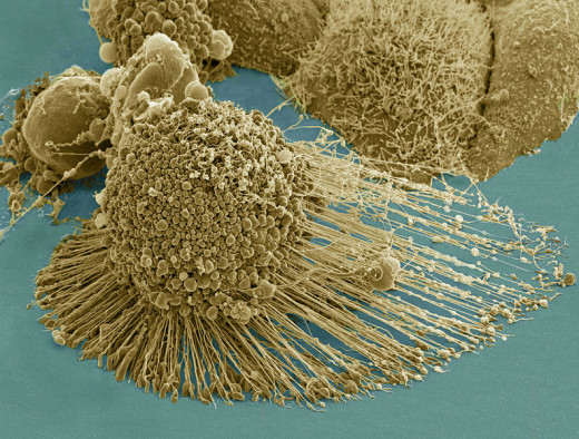  Scanning electron micrograph of an apoptotic (or dead) HeLa cell