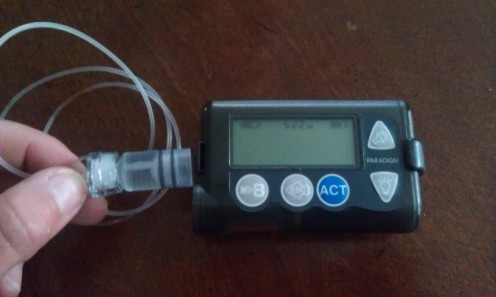 Insulin pumps are often required to treat Type 1 diabetes patients