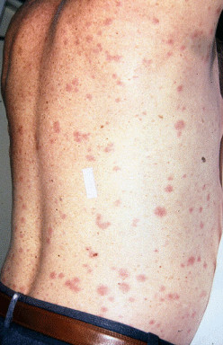 Epidemic Typhus (Louse-Borne Typhus): Pathology, Clinical Manifestations, Diagnosis, Treatment And Prevention