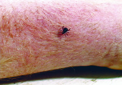 Tick-Borne Relapsing Fever: Clinical Manifestations, Diagnosis, Treatment  And Prevention