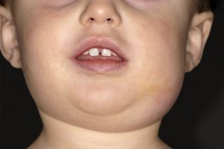 Mumps: Pathology, Clinical Presentations, complications, Diagnosis, Treatment And Prevention