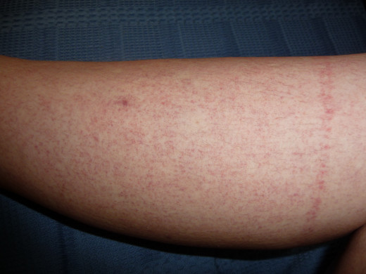 A maculopapular reddish rash occurs on the third to fifth day on the trunk, limbs and face. It disappears as the temperature falls.