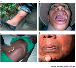 Visceral Leishmaniasis: Health Implications, Epidemiology, Pathology And Transmission
