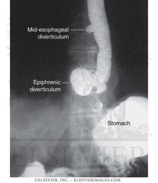 Epiphrenic and Mid-thoracic diverticula