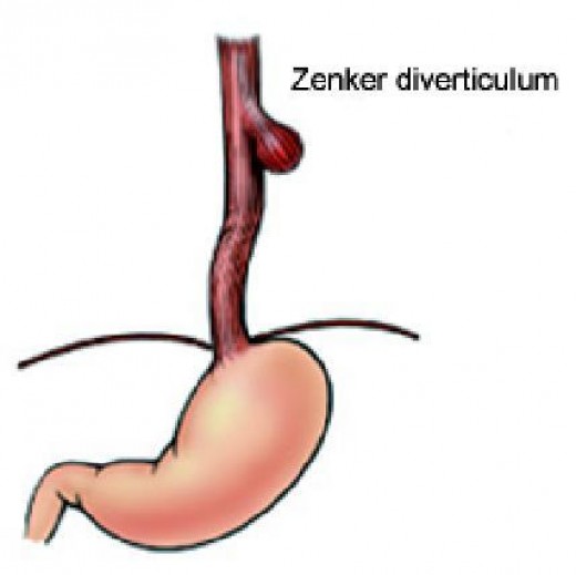 Zenker's diverticulum at the pharyngo-Oesophageal junction (C6). The pouch is a single one.