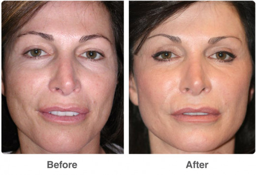 Laser skin resurfacing treatment