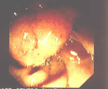 A picture of a polyp similar to mine.  Mine really did look more like a weenie.