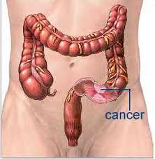 Colorectal cancer