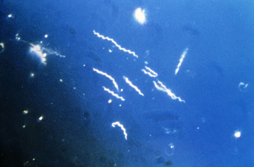 Lyme disease is caused by Borrelia burgdorferi bacteria. 