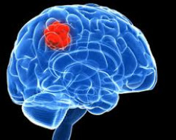 Mental disorders caused by brain tumours