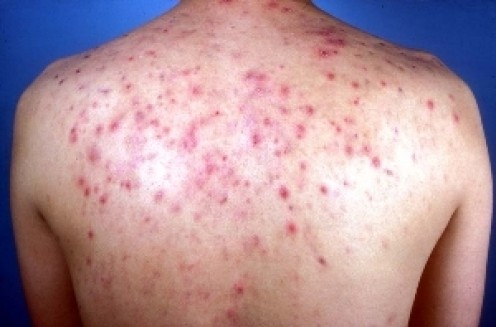 How I Accidentally Treated My Back Acne, (Bacne) after Years of Suffering. Clear Skin and Improved Confidence. How I Accidentally Treated My Back Acne, (Bacne) after Years of Suffering. Clear Skin and Improved Confidence.