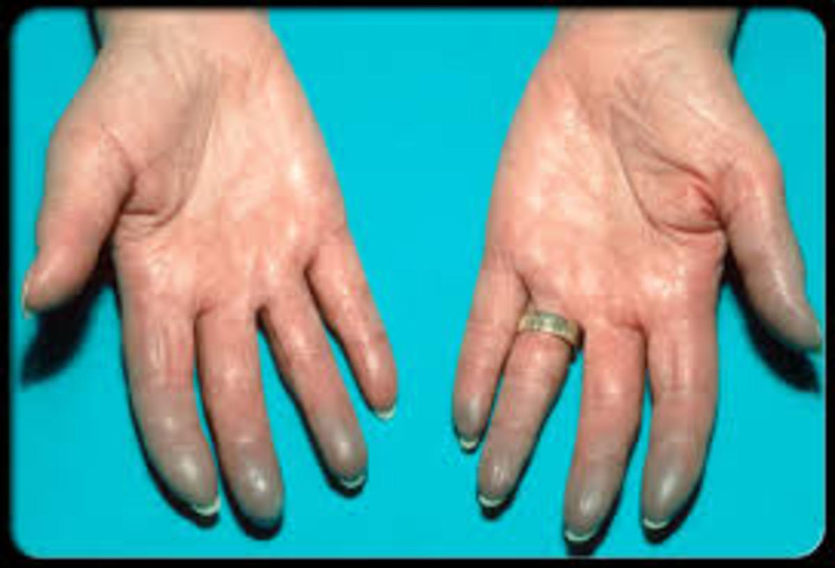 Swollen and blue hands
