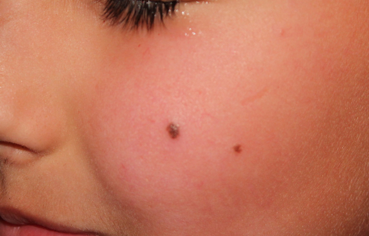 17 Simple Ways To Get Rid Of Moles On Any Part Of The Body