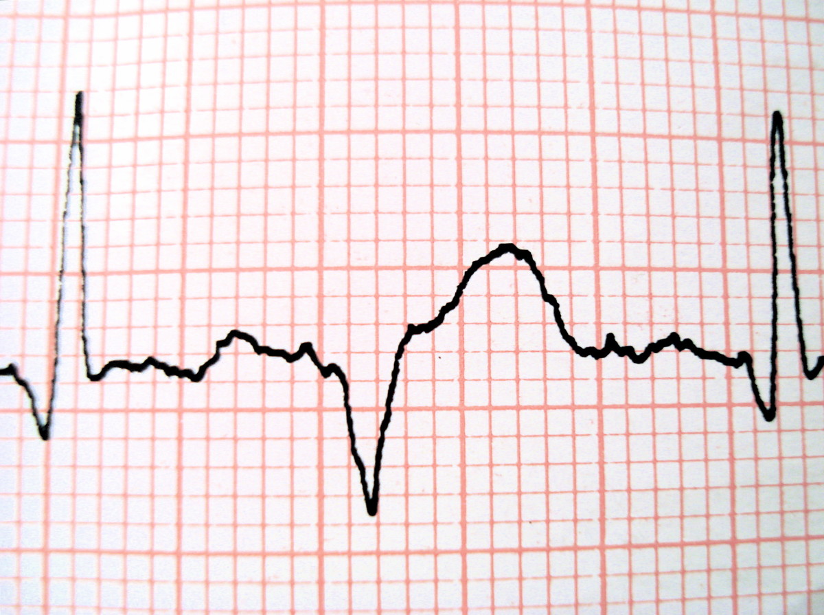 How safe is a cardiac chemical stress test?