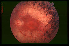 Fundus of patient with retinitis pigmentosa, mid stage (Bone spicule-shaped pigment deposits are present in the mid periphery along with retinal atrophy, while the macula is preserved although with a peripheral ring of depigmentation. Retinal vessels
