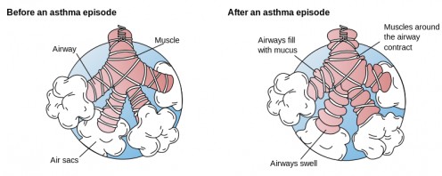Asthma - Before and After