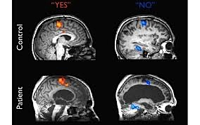 Brain Scans that show the parts of the brain that light up with activity during the questioning of patients diagnosed as in vegetative states.