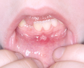 Mouth of a young child with hand,food and mouth disease.