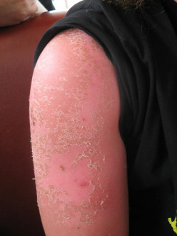 Aloe Vera Sunscreen for Skin Peeling after Sunburn