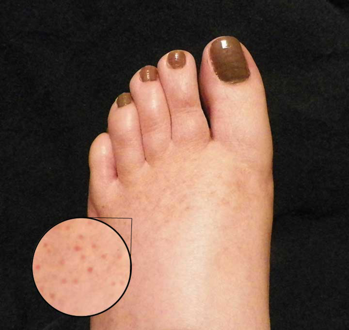 red dots on foot
