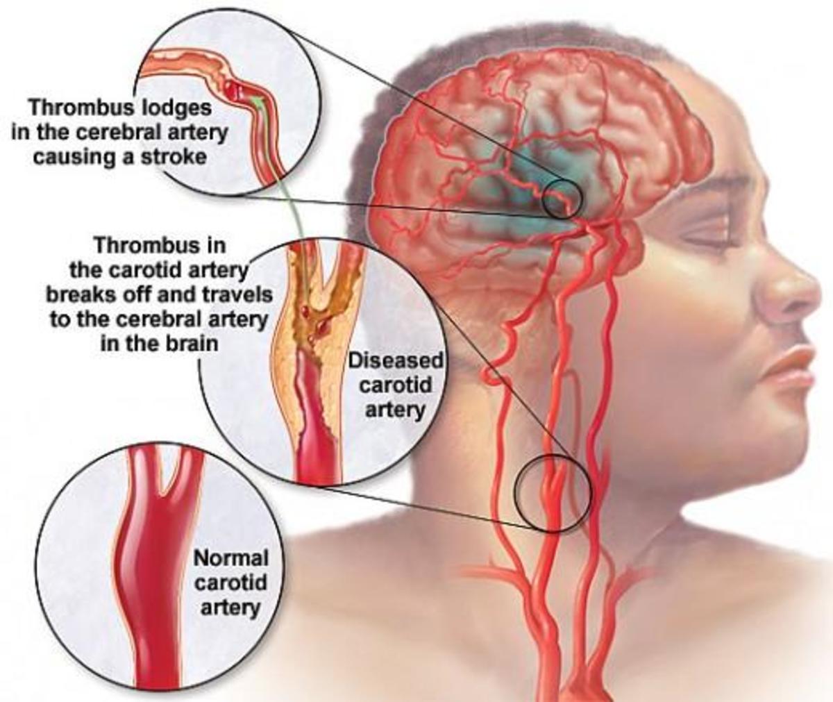 Chelation Therapy Cures Stroke (Blood Clot) - More ...