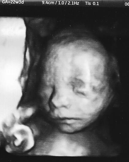  Fetus 23 weeks. That's you Oscar. Yes, you are still a fetus. Keep growing! Don't mind my son: he is still covered in vernix.