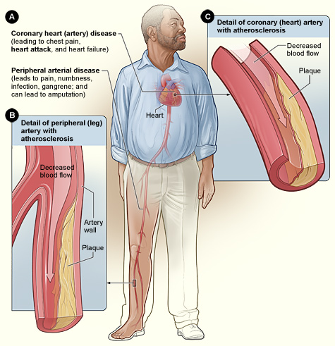 Smoking  and Athelosclerosis