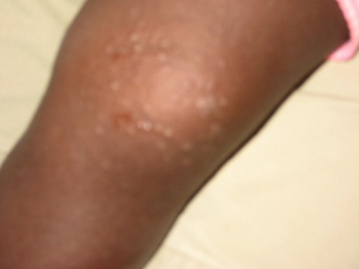This child had a severe outbreak with bumps on most of her skin. This is her knee in early stages