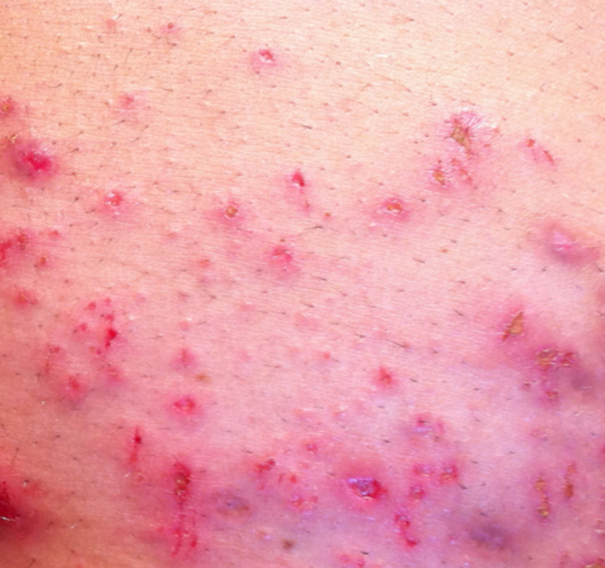 Morgellons Disease – Pictures, Symptoms, Causes, Treatment | HubPages